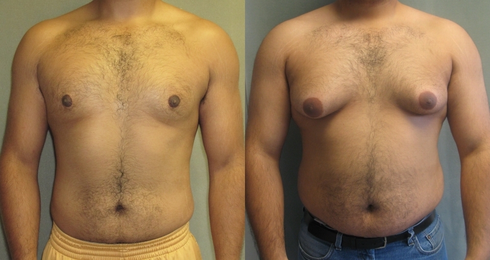 Liposuction for man