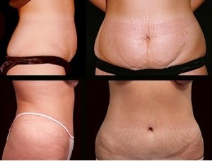 Liposuction