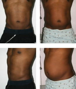 Liposuction result